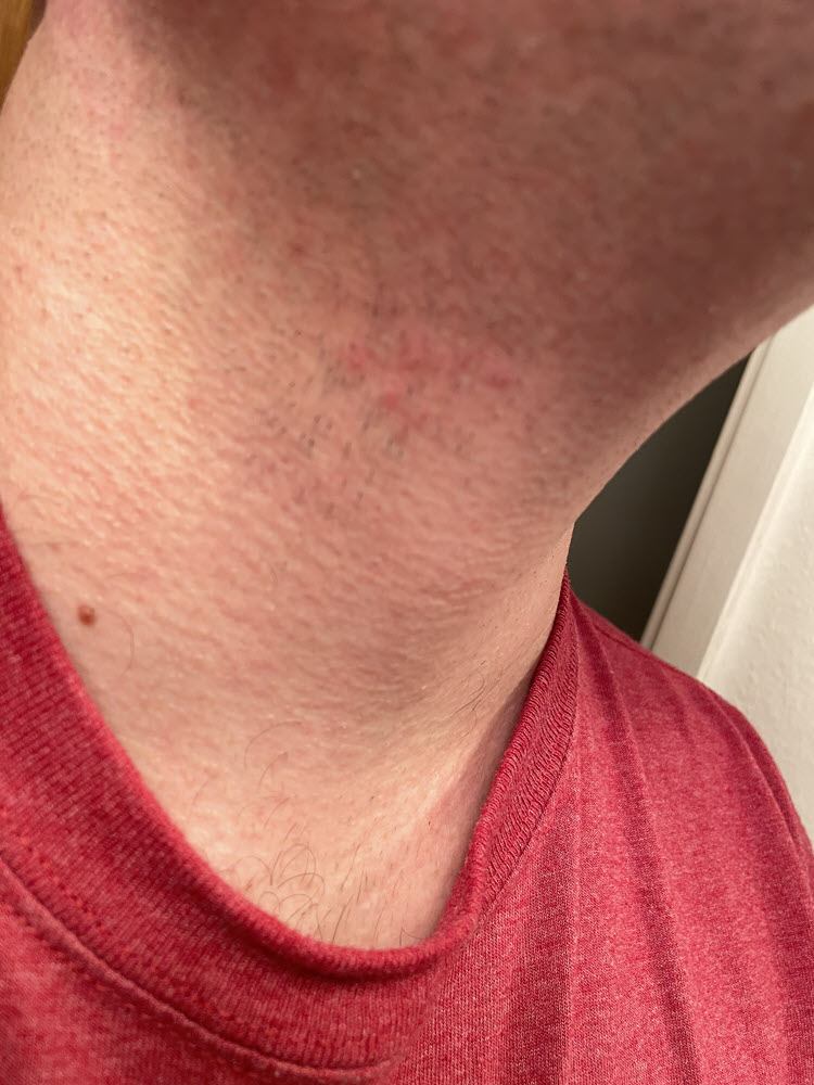 An image showing a picture of author's neck with slight irritation after shaving just slightly above and to the right of his adam's apple.